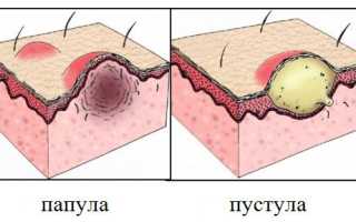 Черный угорь на спине болит