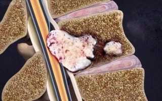 Где болит спина при онкологии