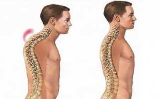 От чего болит горб на спине