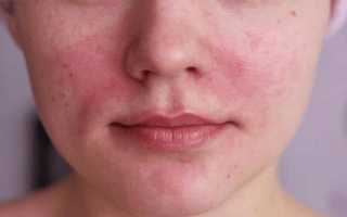 Болит голова красные щеки