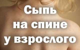 Прыщи на спине чешутся и болят фото