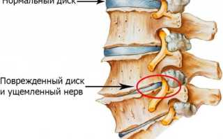 Почему болит поясница если лежать на спине