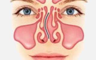Искривлена перегородка в носу может ли болеть голова