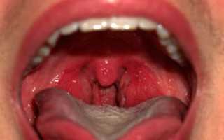 Болит голова и горло температура что делать