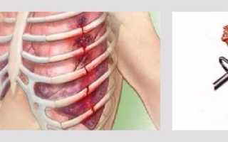 Болит грудина после падения на спину