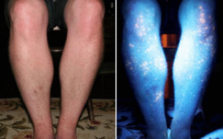 Онкология болят ноги спина