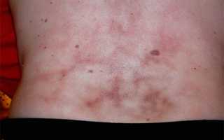 Сколько болит спина при ушибе