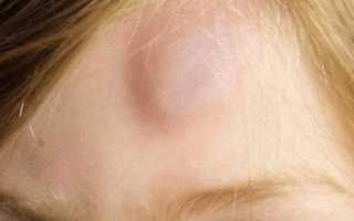 Вскочила шишка на голове и очень болит