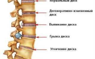 Болит спина вверху печет
