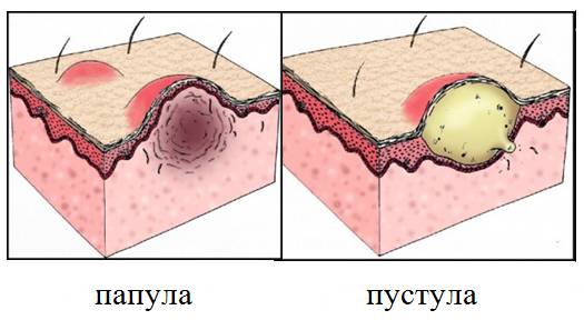 Папула и пустула