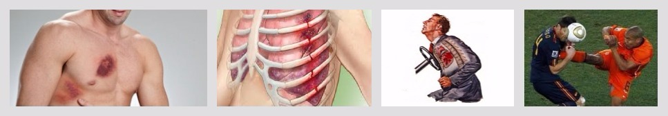 болит грудина после падения на спину