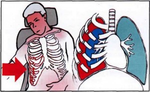 болит грудина после падения на спину