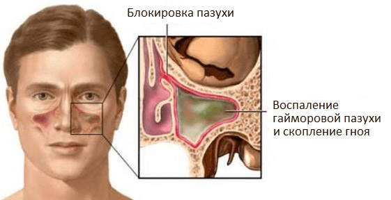 Болит голова высмаркиваюсь с кровью