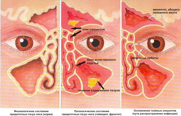 Болит голова высмаркиваюсь с кровью
