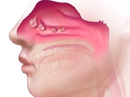 Болит голова высмаркиваюсь с кровью