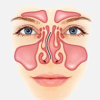 Искривлена перегородка в носу может ли болеть голова