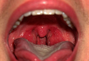 Воспаление горла