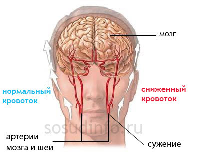 Сужение сосудов болит голова