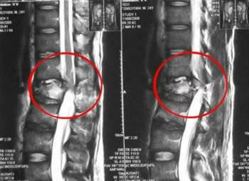 При наклоне головы болит спина и при дыхании