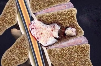 Где болит спина при онкологии