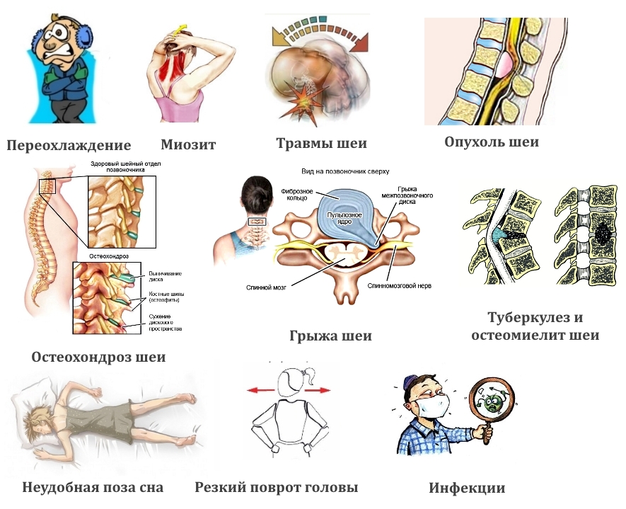 Частые причины боли в шее