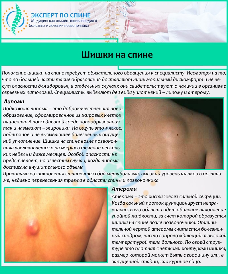 Шишки на спине