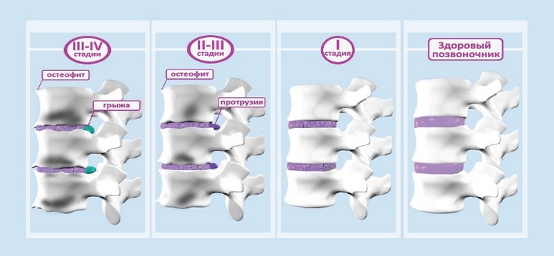 Схематичное изображение дегенеративного процесса, прогрессирующего в тканях позвоночного столба