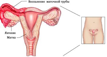 У меня болит спина после месячных