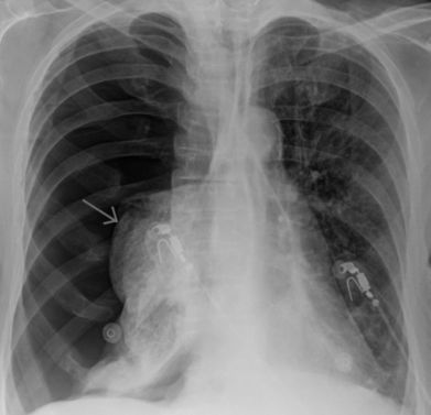 болит правый бок и тянет спину что это может быть