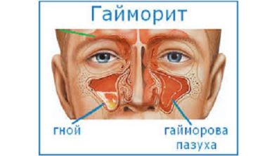 Болит левая сторона спины температура