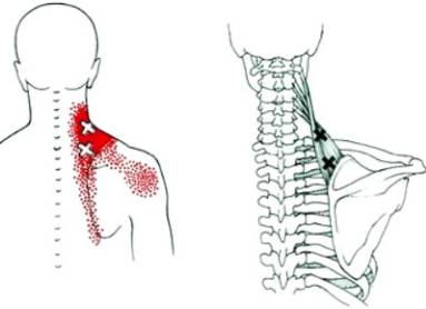 болит спина в районе лопаток и чуть ниже