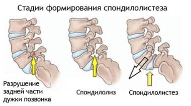Болит спина ниже поясницы при наклоне