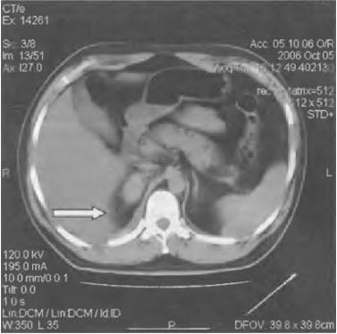 болит правый бок и тянет спину что это может быть