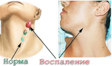 Болит левая сторона спины температура