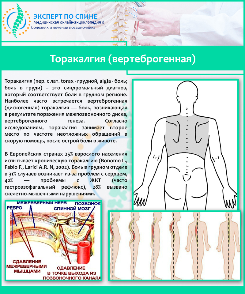 Торакалгия (вертеброгенная)