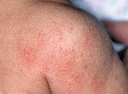 Кожная аллергия 