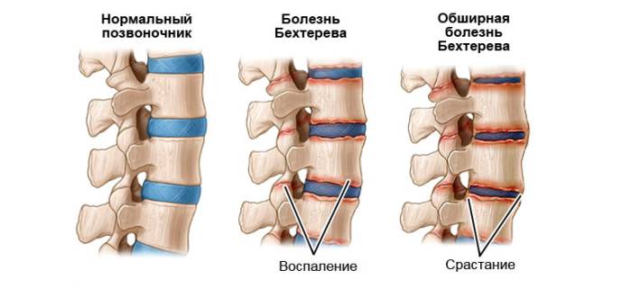 Одной из причин появления болей в спине после сна может быть болезнь Бехтерева