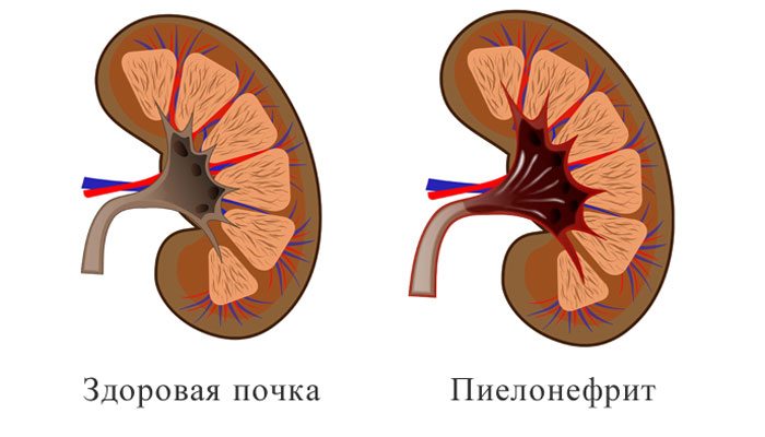 пиелонефрит