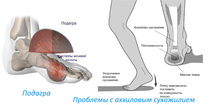 Заболевания пяток Заболевания пяток