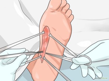 Фасциотомия Фасциотомия