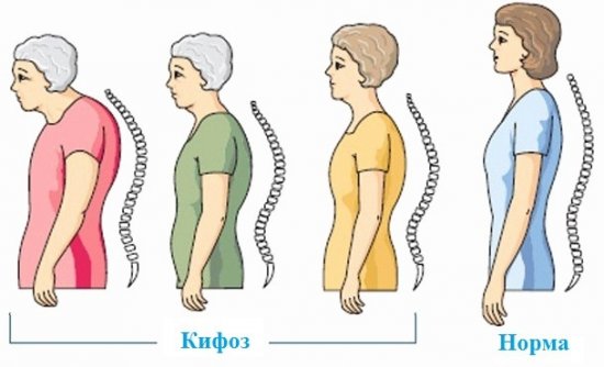 Остеопороз у женщин