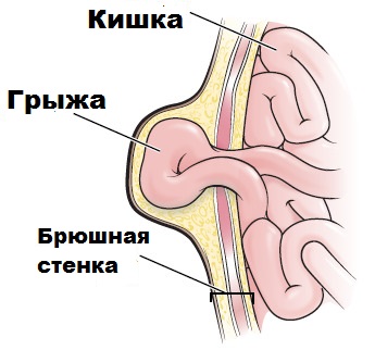 болит живот из за грыжи