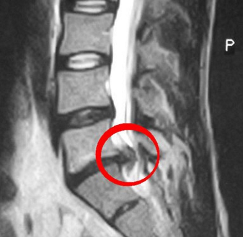 Грыжа позвоночника на рентгене