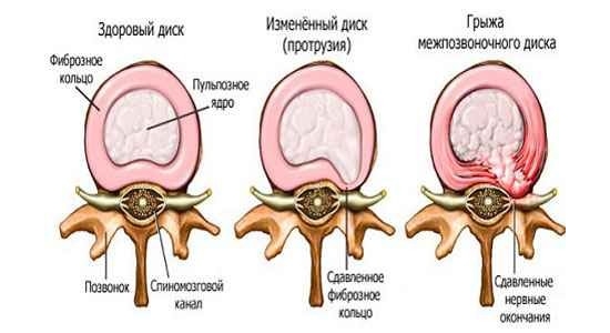Образование грыжи позвоночника