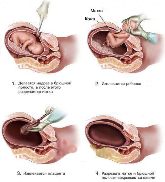 Кесарево сечение при сильной грыже позвоночника