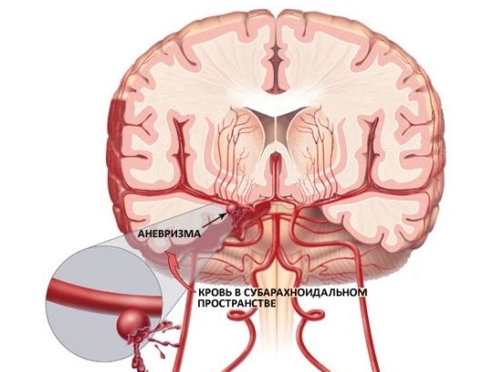 Кровоизлияние в мозг
