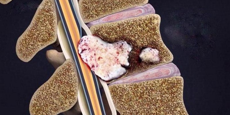 Развитие раковой опухоли в позвоночнике тоже вызывает увеличение и воспаление лимфатических узлов