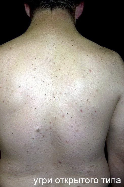 угри открытого типа