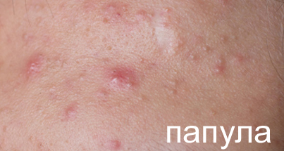 Папула