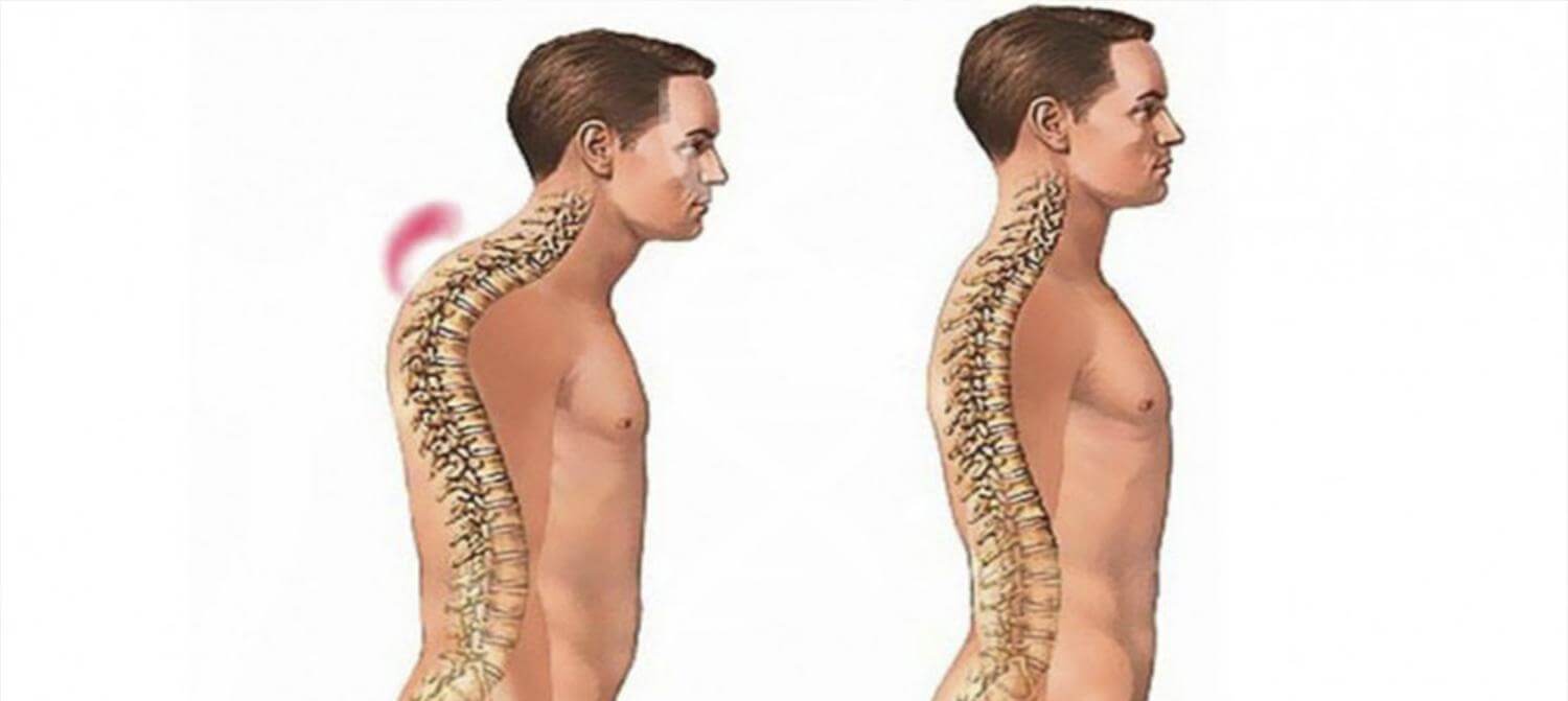 Горб на спине